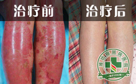 牛皮癣正确诊断与治愈密不可分
