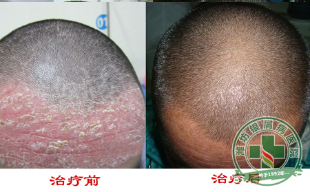 天津西站银屑病治疗病房