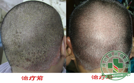 天津牛皮癣医院对牛皮癣治疗优势
